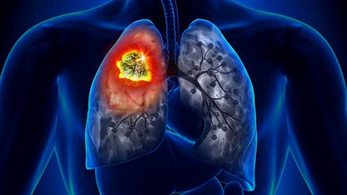 Изображение рака лёгкого