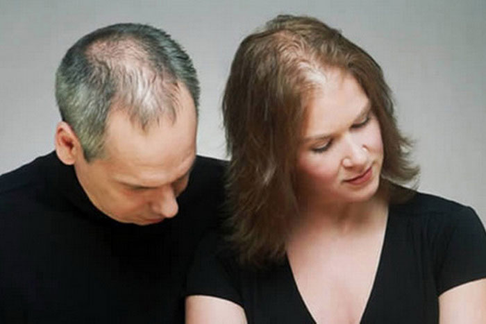 Выпадение волос у мужчины и женщины
