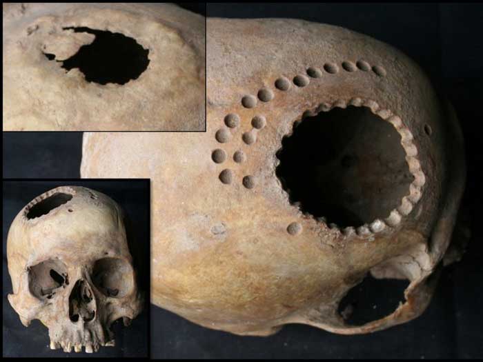 Трепанация черепа в древности